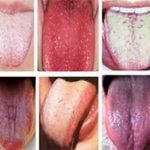 10 языков с различными высыпаниями