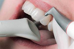 А здесь показан уже сам процесс отбеливания (осветления) зубов по технологии Air Flow.