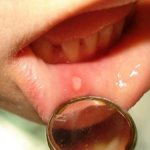 Aphtha on the lip with stomatitis