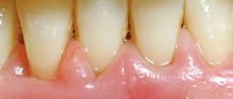 Aggressive periodonitis in a woman