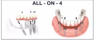 All on 4 implantation price