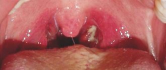 sore throat with scarlet fever