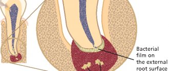 apical periodontitis