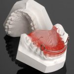 Andresen-Goipl apparatus