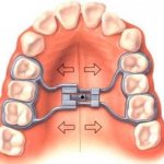 Аппарат норда ортодонтия