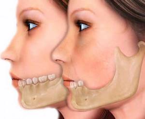 Атрофия костной ткани челюсти: что это такое?