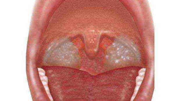 На гландах белые точки: что делать? Как лечить гланды?