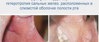 White spots on the lips, small pimples. Causes of rash, treatment of Fordyce granules