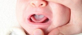white coating on the baby's tongue