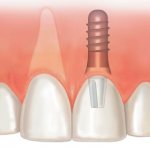 бескровная имплантация