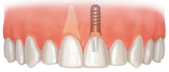 бескровная имплантация