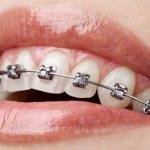 Безлигатурные брекеты damon q металлические фото