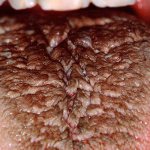 болезнь черного волосатого языка