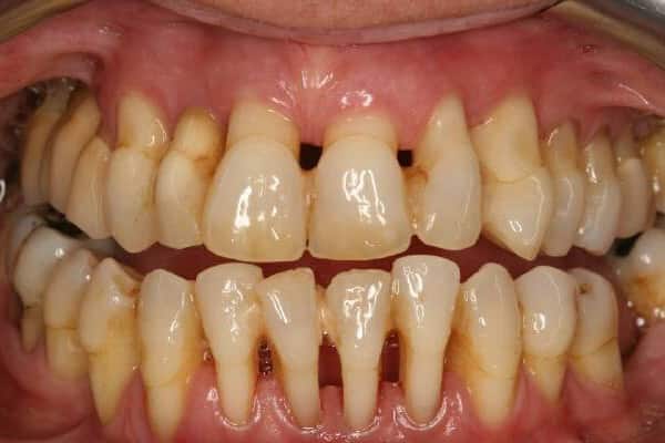 болит передний верхний зуб при нажатии