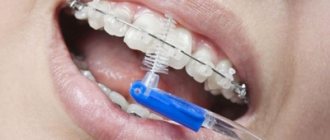 Болят зубы после установки брекетов: как долго терпеть и что делать?