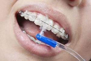 Болят зубы после установки брекетов: как долго терпеть и что делать?