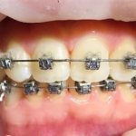 bracket system mini master