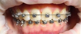 bracket system mini master