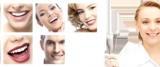 awning braces