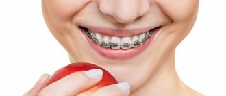 braces
