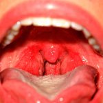 Severe hyperemia without the presence of ulcers is striking.