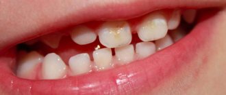 bottle caries in children