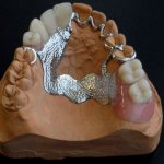 Бюгельные протезы для зубов