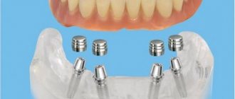 Бюгельные протезы отзывы пациентов, рекомендации стоматологов