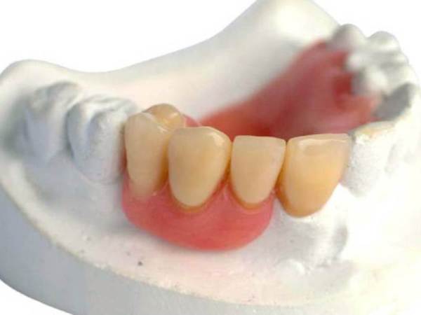 Частичные покрывные зубные протезы