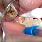 Чем больше каналов в зубе мудрости, тем дороже обойдется его лечение при пульпите.
