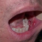 Чем лечить воспаление околоушной слюнной железы