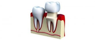 чем отличаются штампованные коронки для зубов от литых