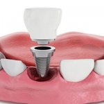 Чем отличаются зуб на штифте и имплантация зуба