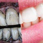 Чистка зубов активированным углем