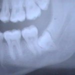 Что делать, если раскрошился зуб мудрости. Нужно ли его удалять