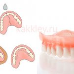 что делать если треснул протез
