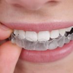 What are invisalign aligners and why are they good?
