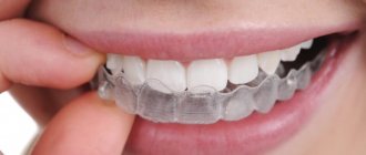 что такое каппы invisalign, чем они хороши