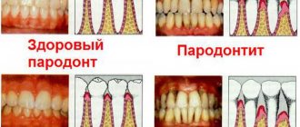 What is gum coagulation? Why do dentists do cauterization of mucous tissues?