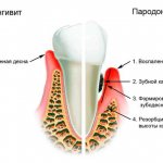 что такое пародонтит