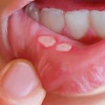 Что такое стоматит