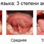 Что такое уздечка