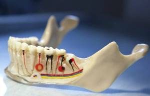 Цистэктомия кисты зуба