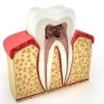 Даже зуб, лишенный нерва, может болеть