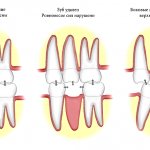 Деформация зубного ряда в результате удаления зуба