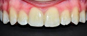 Демнинерализация: белые пятна на зубах