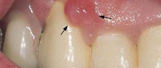 Десневой нарост эпулис