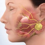 Diagnosis and treatment of dental phlegmon