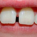 диастема между зубами