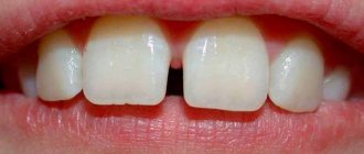 diastema between teeth